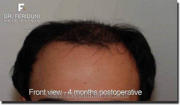 Hair restoration procedure results