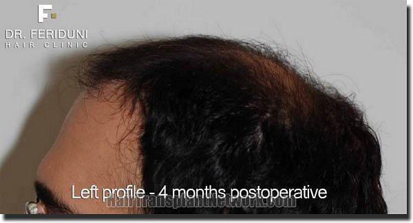 Hair restoration procedure results