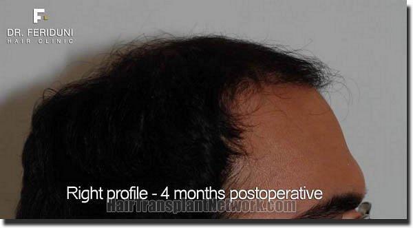 Hair restoration procedure results