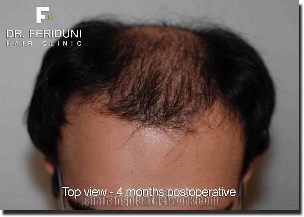 Hair restoration procedure results