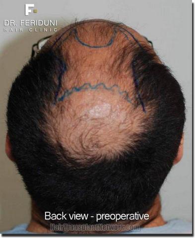 Hair restoration procedure results