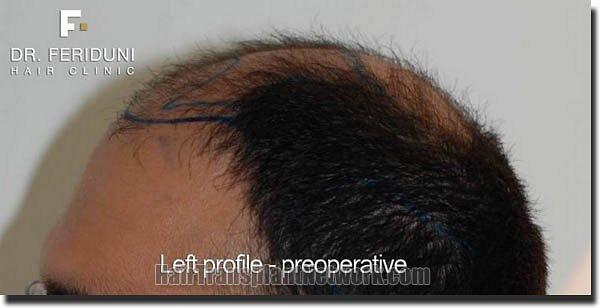 Hair restoration procedure results