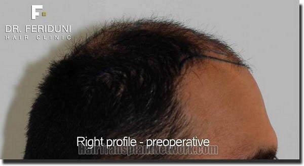 Hair restoration procedure results