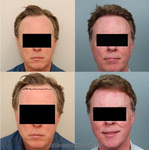 Before and after hair restoration patient photographs