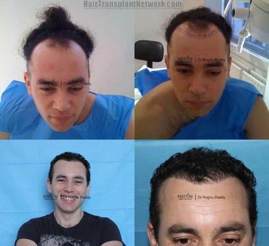 Hair transplantation surgery before and after pictures