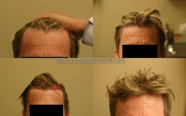 Hair restoration procedure before and after results