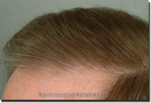 Hair restoration procedure results