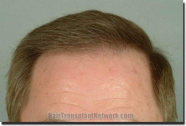 Hair restoration procedure results