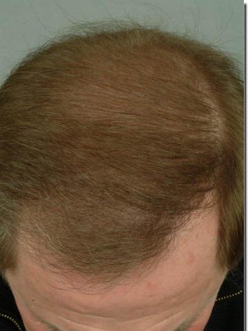 Hair restoration procedure results