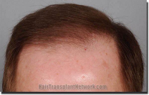 Hair restoration procedure results