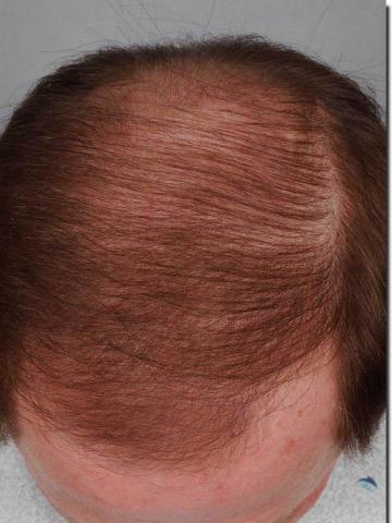 Hair restoration procedure results