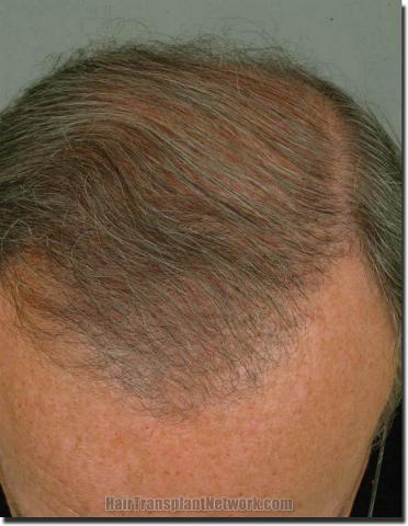 Hair restoration procedure results