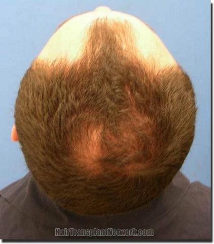 Hair restoration procedure results