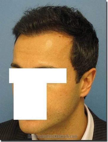 Hair restoration procedure results