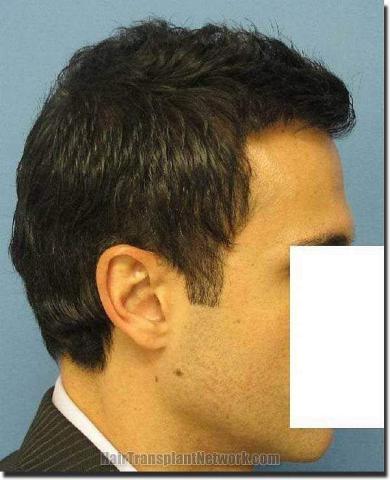 Hair restoration procedure results