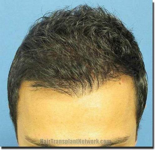 Hair restoration procedure results