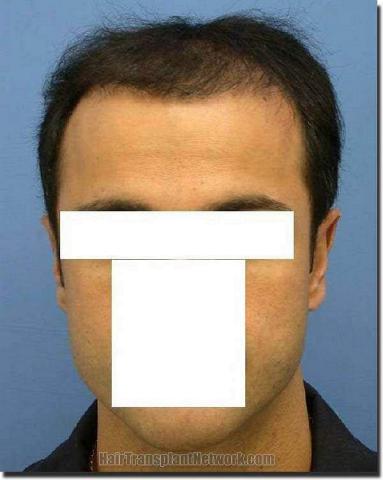 Hair restoration procedure results