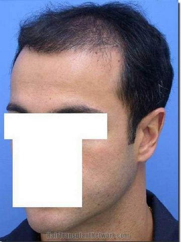 Hair restoration procedure results