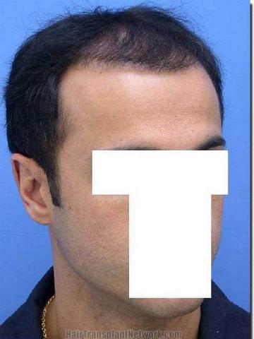 Hair restoration procedure results