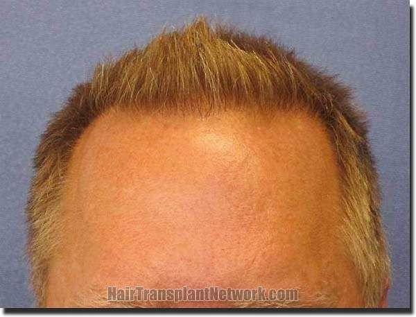 Hair restoration procedure results