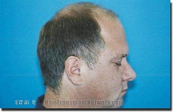 Hair restoration procedure results