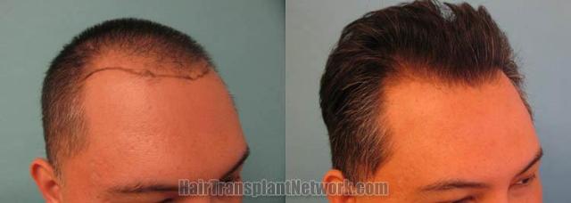 Hair transplantation surgery before and after images