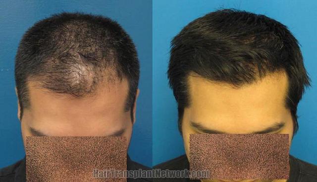 Hair transplantation surgery before and after pictures