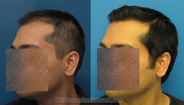 Hair transplantation surgery before and after photos