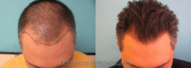 Hair transplantation surgery before and after photos