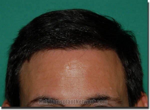 Hair restoration procedure results