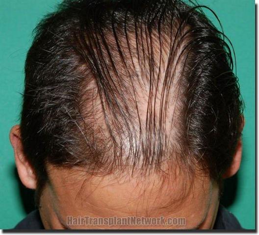 Hair restoration procedure results