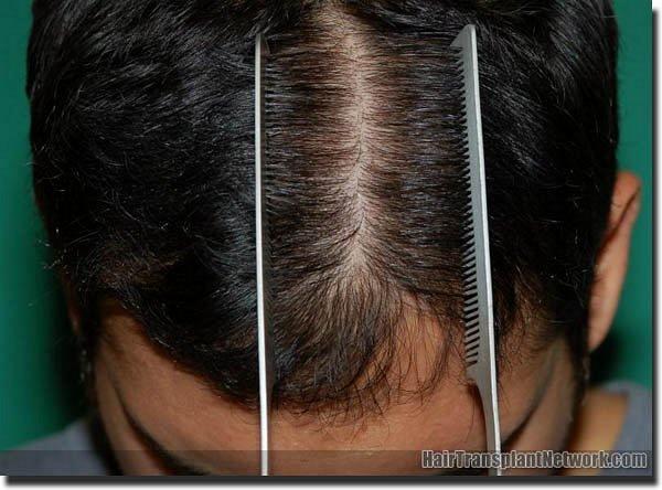 Hair restoration procedure results