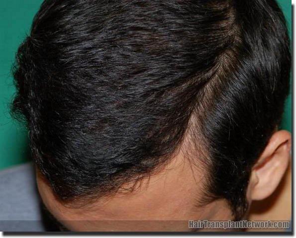 Hair restoration procedure results