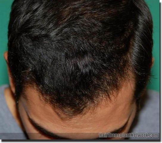 Hair restoration procedure results