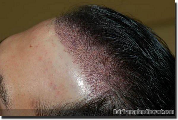 Hair restoration procedure results