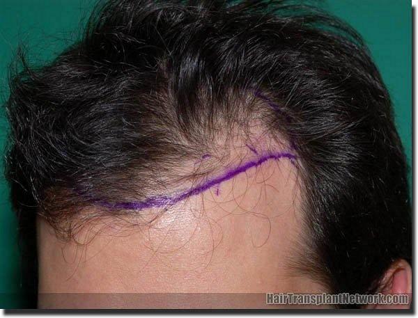 Hair restoration procedure results