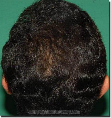 Hair restoration procedure results