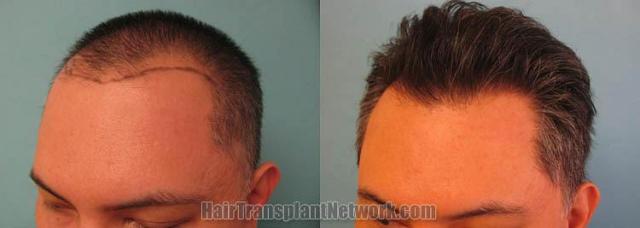 Hair restoration procedure before and after pictures