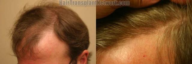 Hair transplantation surgery before and after pictures