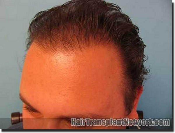 Hair restoration procedure results