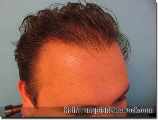 Hair restoration procedure results