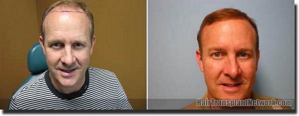 Hair restoration procedure results