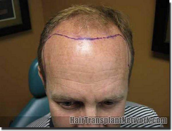 Hair restoration procedure results