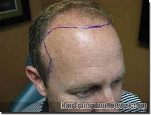 Hair restoration procedure results