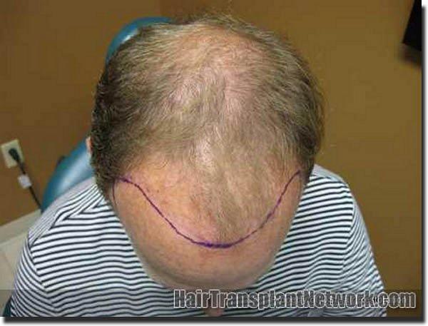 Hair restoration procedure results