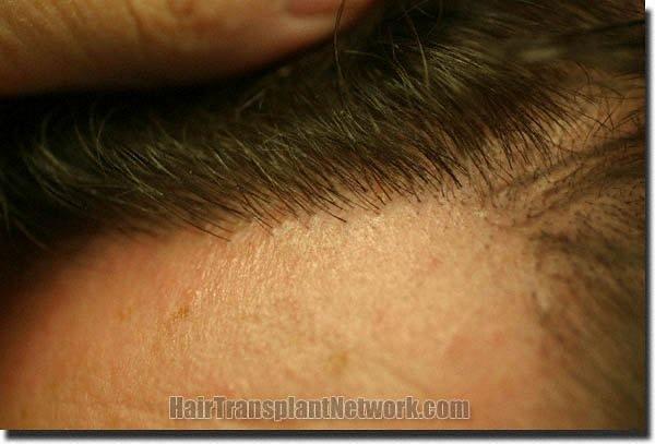 Hair restoration procedure results