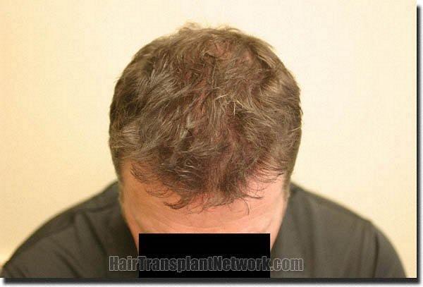 Hair restoration procedure results