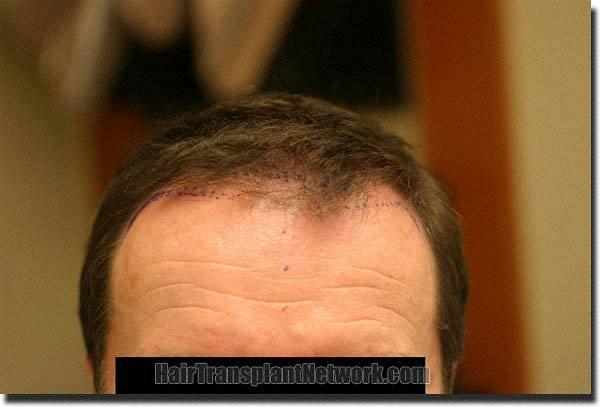 Hair restoration procedure results