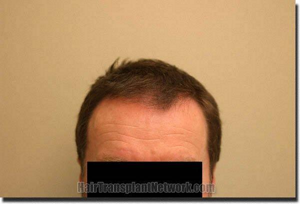 Hair restoration procedure results