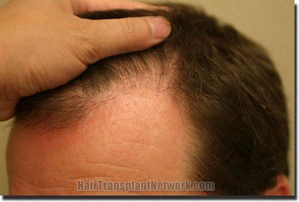 Hair restoration procedure results